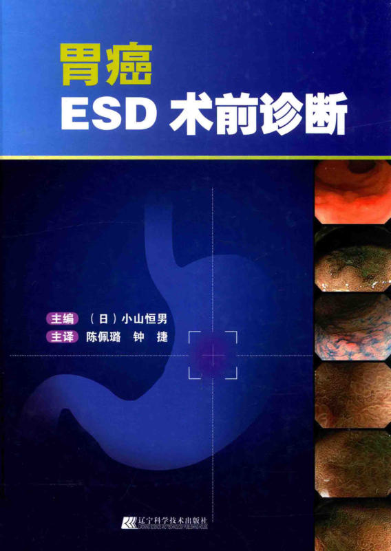 胃癌ESD术前诊断