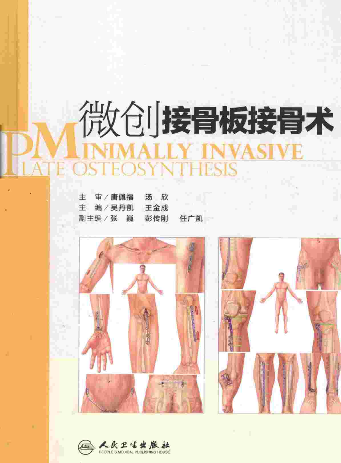 微创接骨板接骨术
